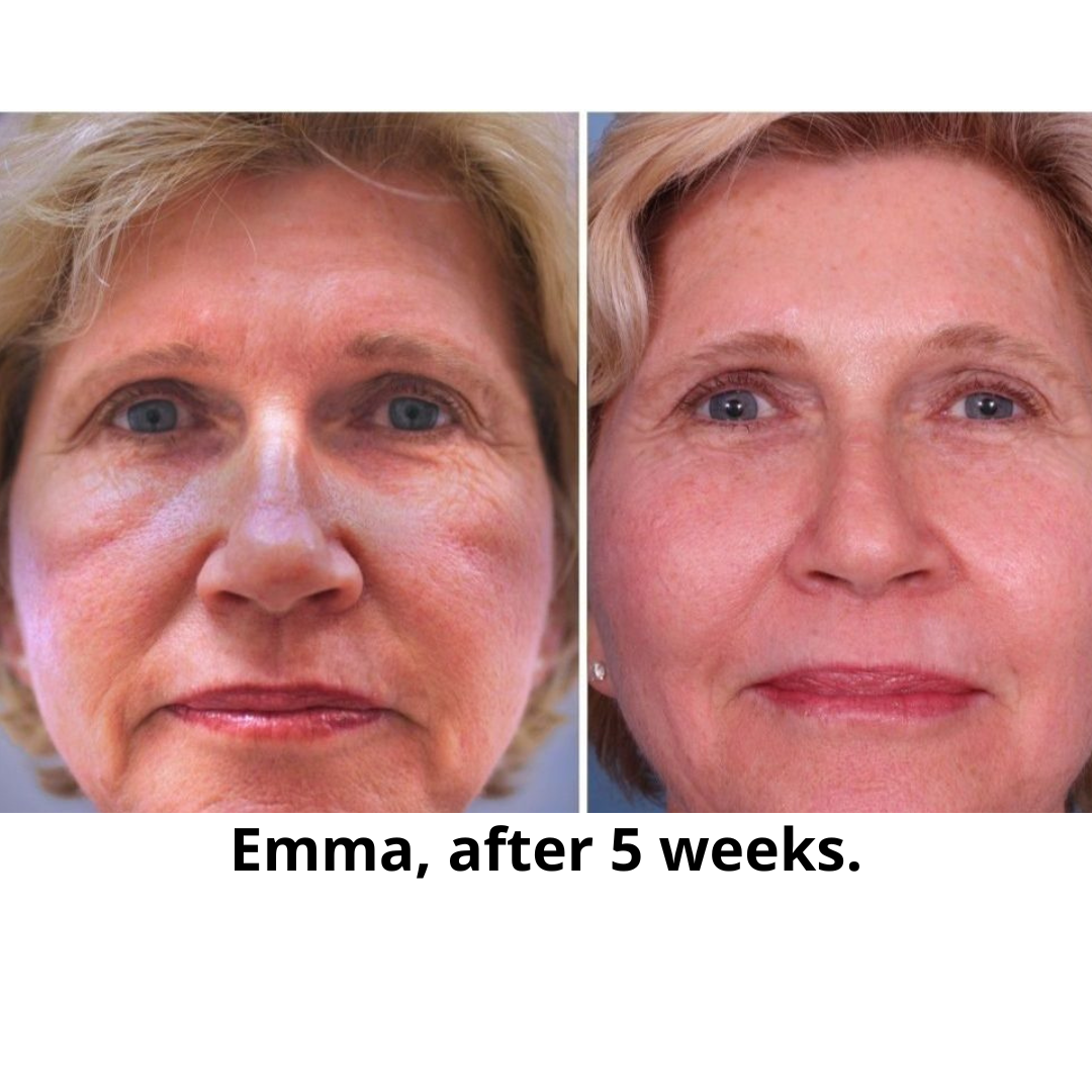 Glow up led mask